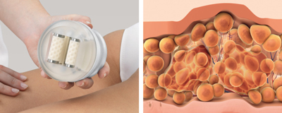 média: esthetique/soup-massageconjonctif.jpg