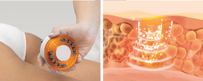 média: esthetique/soup-ultrasons.jpg